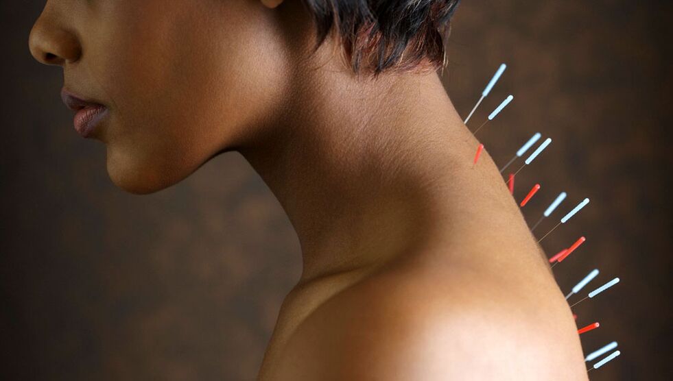 Akupunktūra ar dzemdes kakla osteohondrozi