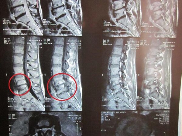 Dzemdes kakla osteohondrozes diagnoze