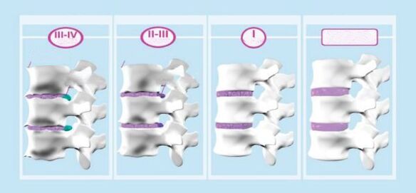 Dzemdes kakla osteohondrozes posmi