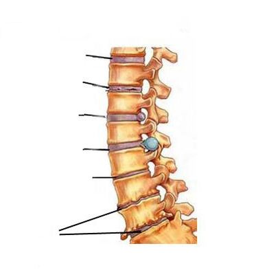 Kā attīstās osteohondroze