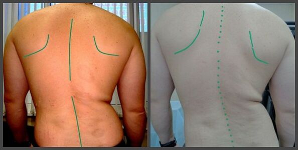 Mugurkaula izliekums ar osteohondrozi