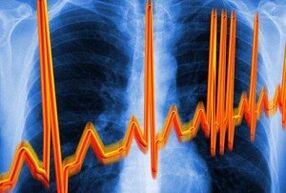 Sirds aritmija osteohondrozei