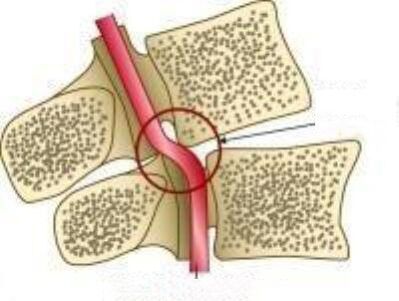 Vail artērijas sindroms