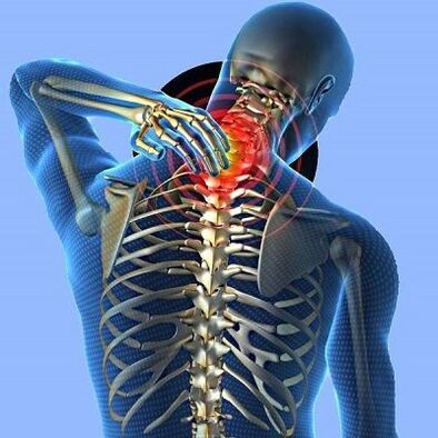 kakla sāpes ar dzemdes kakla osteohondrozi