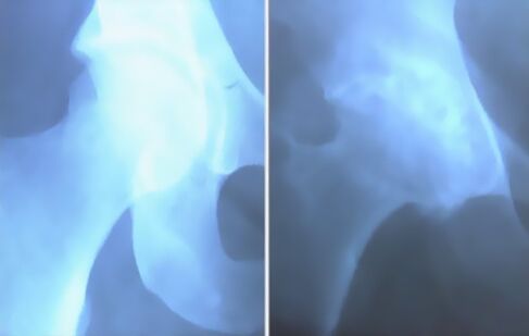 Ceļa locītavas artroze