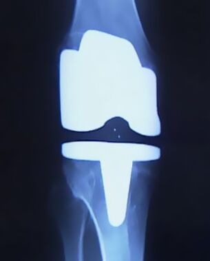 X -Ray ceļgala attēls ar mākslīgu protēzi pēc operācijas, lai mainītu locītavu