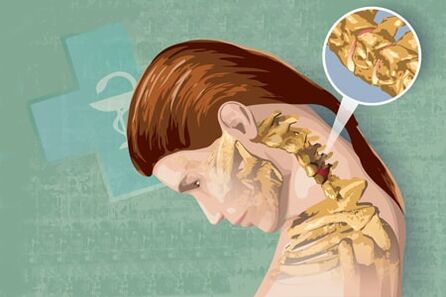 Osteohondrozes refleksa simptomi